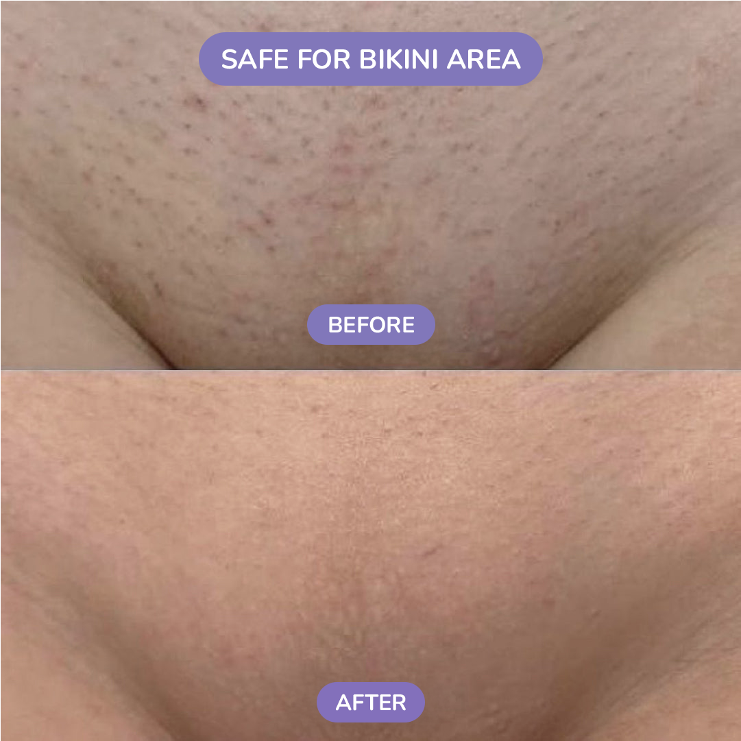 💎 Crystal Hair Remover